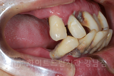 강남역 전체임플란트 치과 "치아가 심하게 흔들려요." 심한 치주염 임플란트 치료 관련 이미지 23