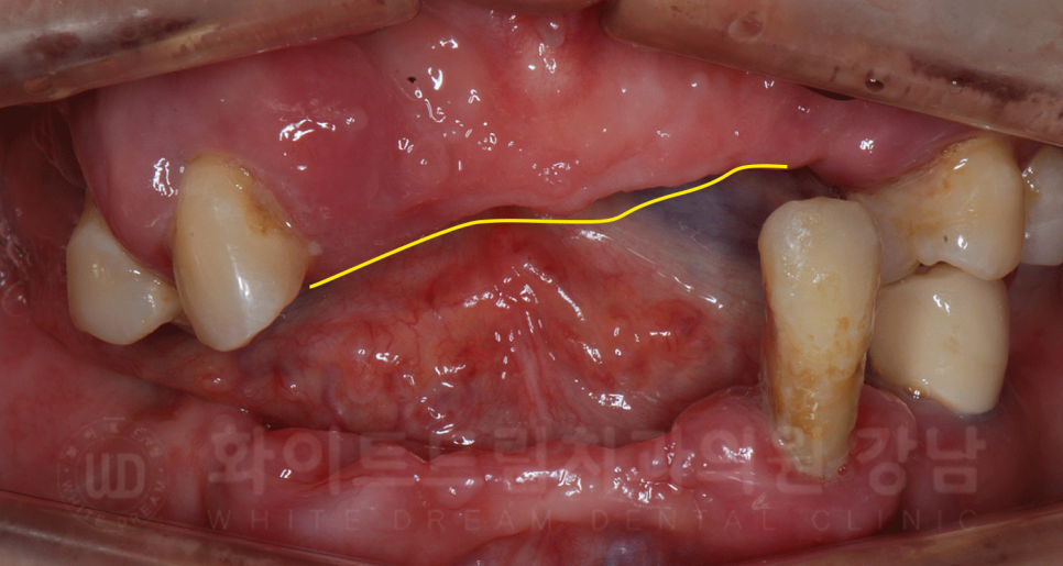 강남역 임플란트 치과 "틀니가 안 맞아서 불편해요" 틀니 → 전체 임플란트로! 관련 이미지 2