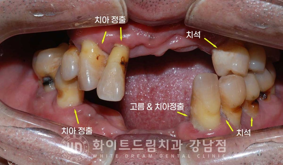 치주염 전체임플란트, 염증으로 인한 상악동 천공 & 신경관 가까이 녹은 잇몸뼈. 임플란트 식립 가능할까? 관련 이미지 3