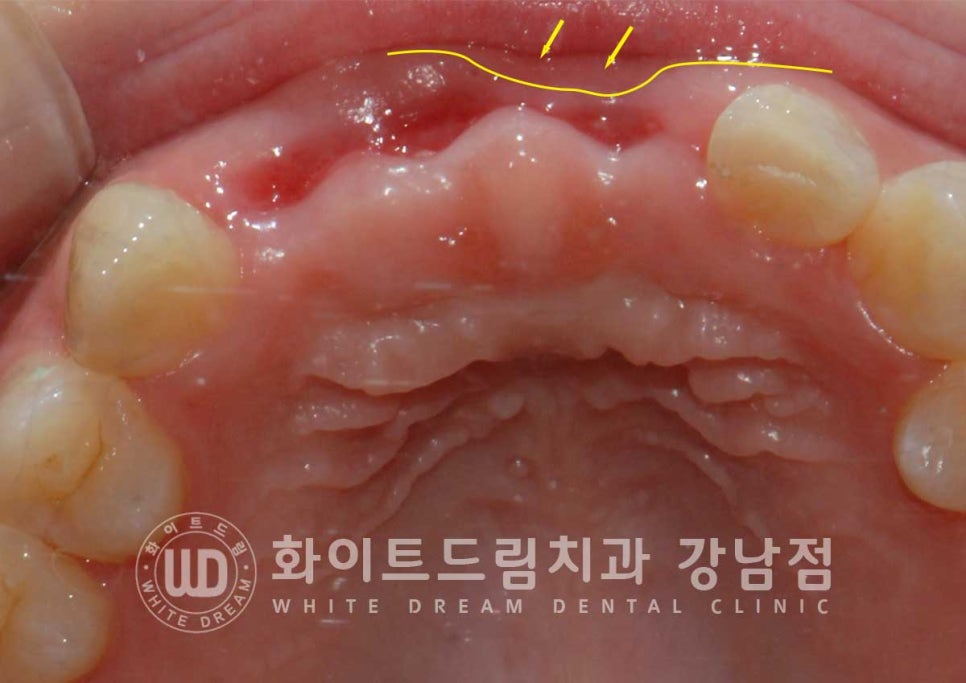 앞니 빠짐 임플란트 / 사고로 인한 앞니 탈구. 앞니 임플란트 치료는? 관련 이미지 5