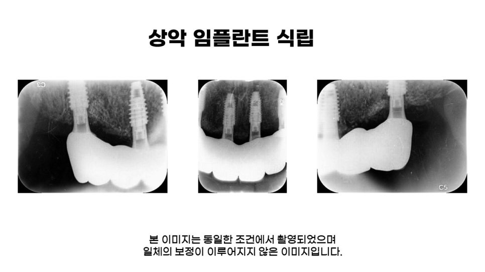 40대임플란트식립후기 및 어금니임플란트 가격, 종류 알아보기 위해 관련 이미지 13