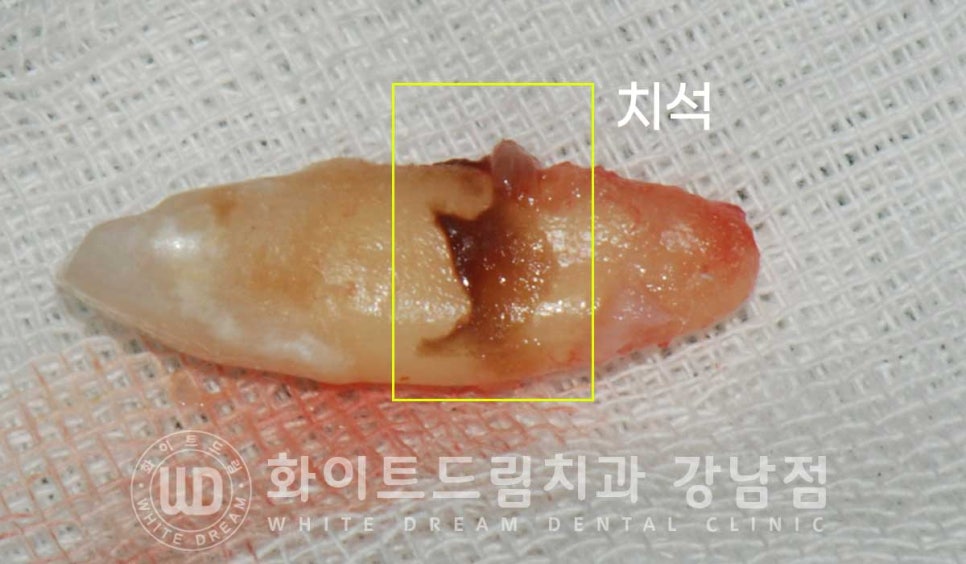 사고당한 앞니치료, "흔들리고 점점 변색돼요." 앞니 임플란트 & 신경치료 관련 이미지 9