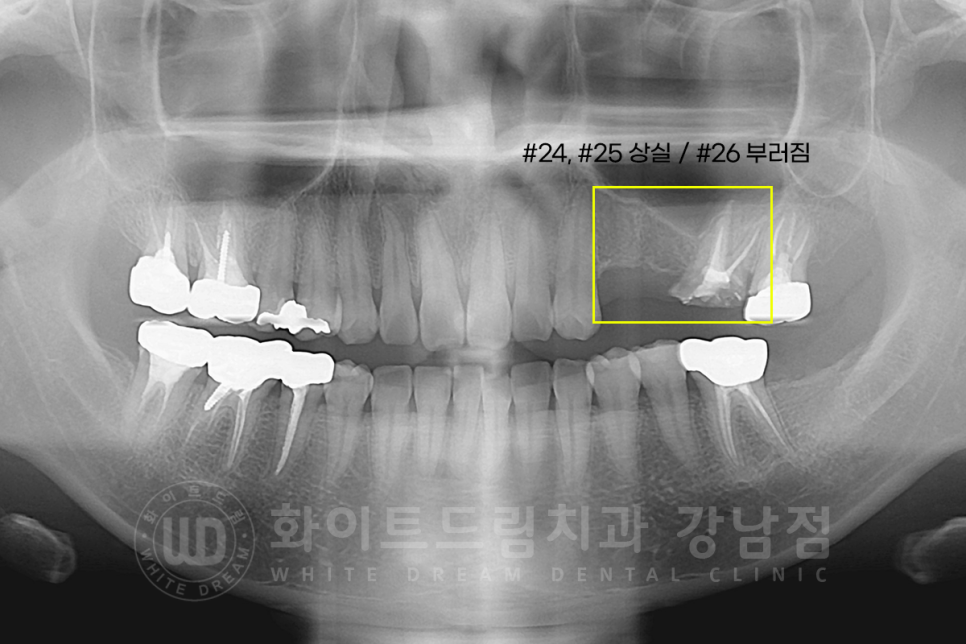 강남역 어금니 임플란트 "어금니가 부러졌어요" 상악동 거상술(lateral approach) 관련 이미지 3