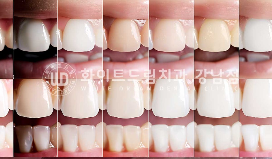 벌어지고 깨진 앞니, 웨딩 앞니 라미네이트 치료 사례 "남자도 자연스럽게 라미네이트 가능한가요?" 관련 이미지 16