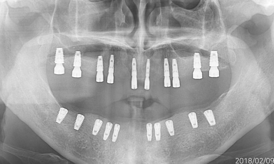 임플란트 하기 전 알아보아야 할 것. 관련 이미지 16