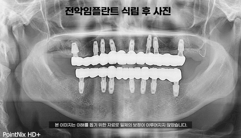 40대 전악 임플란트 식립 증례 관련 이미지 4