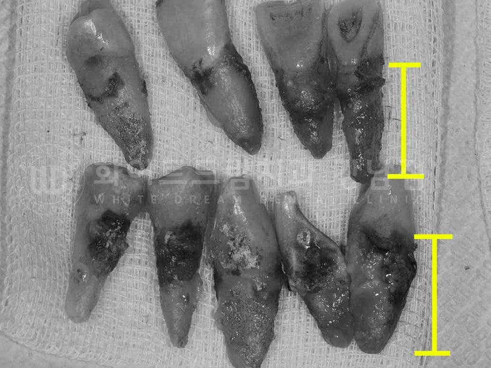 강남역 전악 임플란트 "치아가 흔들리고 빠져요!" 치주염 임플란트 치료 관련 이미지 3