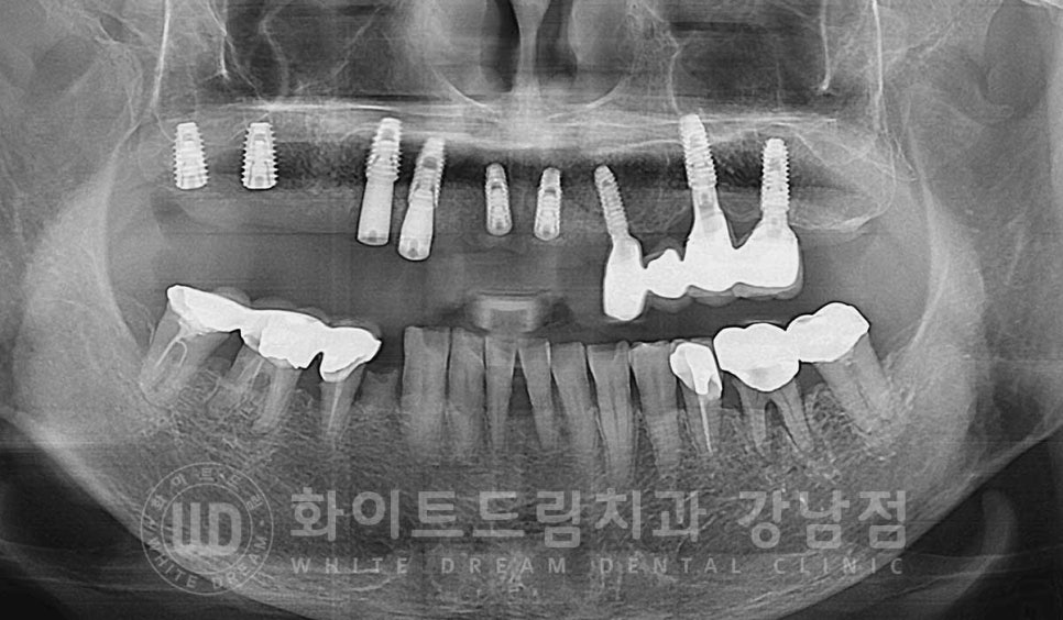 임플란트 1차 수술, 2차 수술이란 무엇일까? (+ 상악 전체 임플란트 치료 기간) 관련 이미지 7