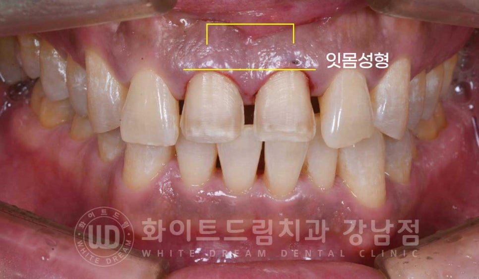 벌어지고 깨진 앞니, 웨딩 앞니 라미네이트 치료 사례 "남자도 자연스럽게 라미네이트 가능한가요?" 관련 이미지 9