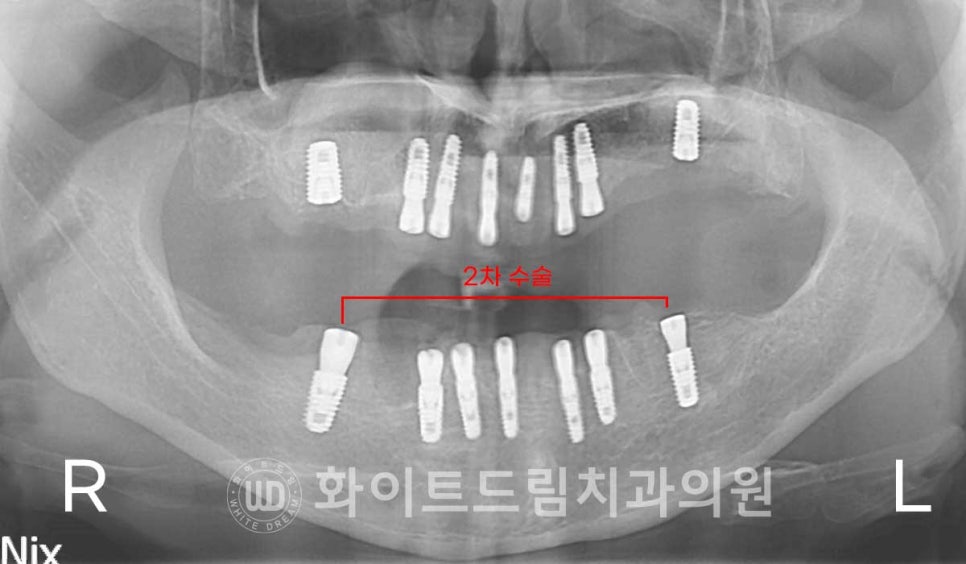 강남역전체임플란트 / 발치 후 즉시 식립, 무조건 누구나 3개월로 끝낼 수 있는 것일까? 강남역화이트드림치과 관련 이미지 15