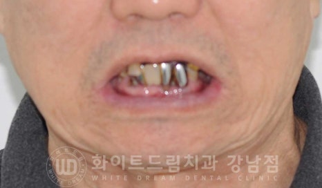 전체 임플란트 치료 기간과 내원 횟수는? "치과에 자주 가기 어려워요." 관련 이미지 2