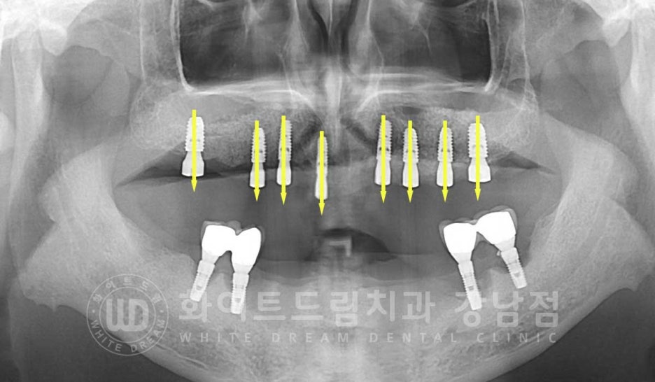 Gangnam Station Dental Clinic Specializing in Implant Revision Surgery—Revision Surgery and Full-Mouth Implant Treatment at the Same Time! image 5