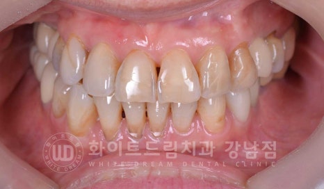 노화된 치아 라미네이트 / 치아미백을 해도 하얘지지 않는 마모된 치아는 어떻게 할까? 관련 이미지 13