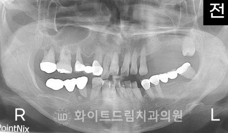 강남역전체임플란트 / 발치 후 즉시 식립, 무조건 누구나 3개월로 끝낼 수 있는 것일까? 강남역화이트드림치과 관련 이미지 16