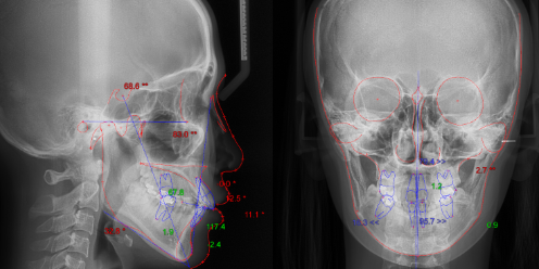 치아교정, 꼭 해야 한다면 미리 알아 두자. 관련 이미지 29