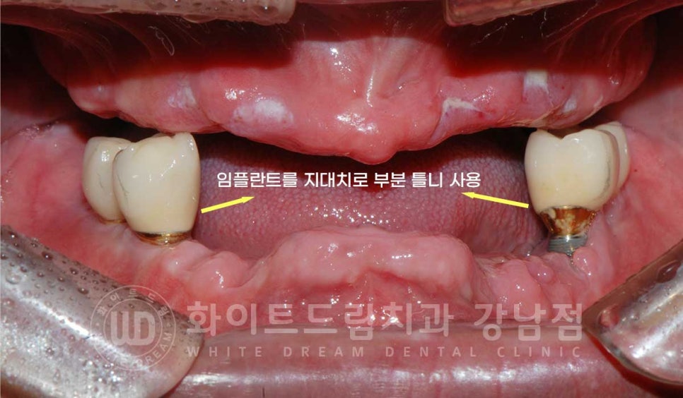 임플란트 재수술 잘하는치과 / 재수술과 전체 임플란트 치료를 동시에! 관련 이미지 1