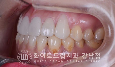 치경부착색 치료 / 라미네이트 vs 올세라믹 치아 삭제량 비교 (Feat. 라미네이트 후 치아미백 가능한가요?) 관련 이미지 13