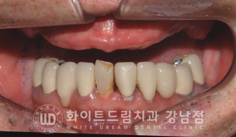 상악 풀케이스임플란트 사례 "부산에서 강남까지 왔어요" 관련 이미지 2
