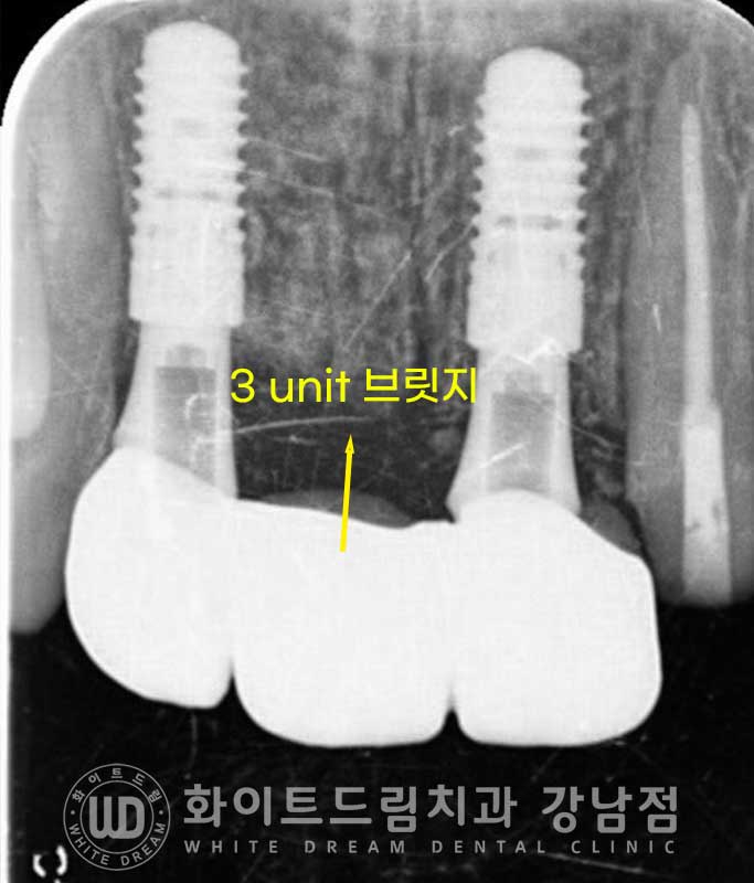 앞니 빠짐 임플란트 / 사고로 인한 앞니 탈구. 앞니 임플란트 치료는? 관련 이미지 7