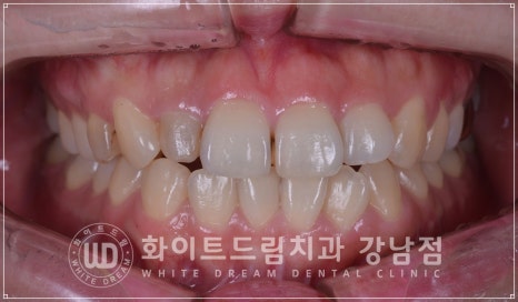 역삼역 왜소치치료 / 치아 하나가 너무 작아요. 왜소치 라미네이트 잘하는 치과 관련 이미지 1