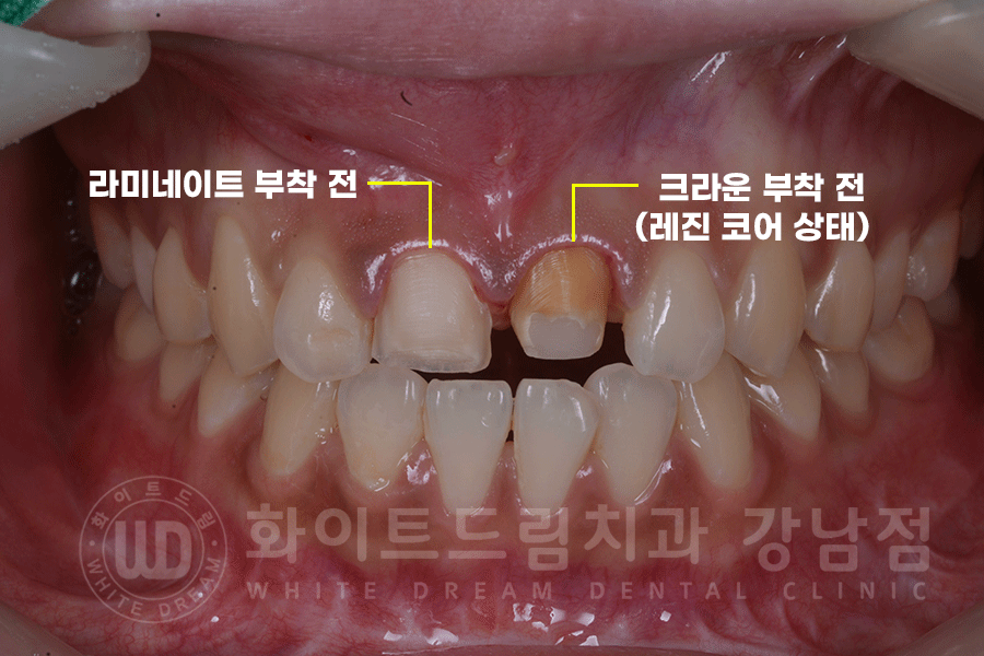 강남역 주변 치과 "10년 된 앞니가 변색됐어요" 앞니 심미 치료 관련 이미지 8