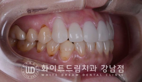 치경부착색 치료 / 라미네이트 vs 올세라믹 치아 삭제량 비교 (Feat. 라미네이트 후 치아미백 가능한가요?) 관련 이미지 14
