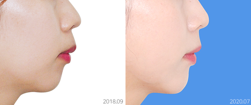 얼굴공개없는 치아교정 모델 모집 관련 이미지 9