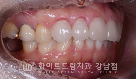 앞니 원데이라미네이트 / 떨어진 앞니 레진 & 벌어진 앞니, 라미네이트로 당일 개선 ★ 관련 이미지 13