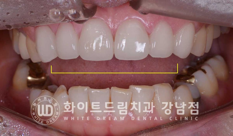 앞니 원데이라미네이트, 뻐드러지고 벌어진 앞니! 당일 치료 ok 관련 이미지 16