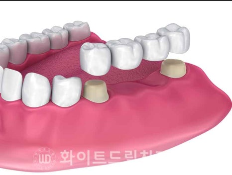 서울전체임플란트잘하는치과, 왜 치주염이 심해지면 반대교합까지 생길까요? (치주염 전체 임플란트 CASE) 관련 이미지 10