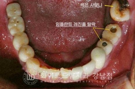 임플란트 재수술의 주원인, "임플란트 주위염과 임플란트 찢어짐!" 관련 이미지 6