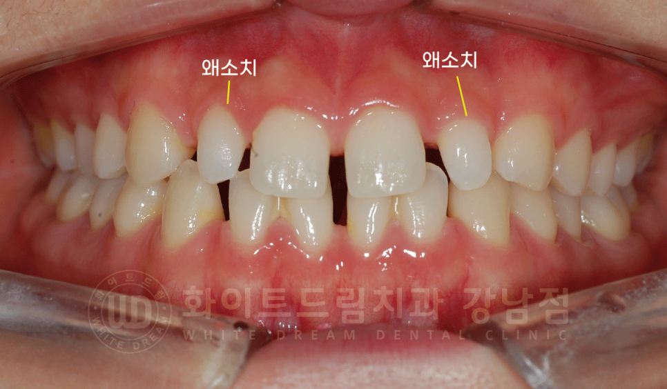 강남 벌어진앞니 교정 / "심하게 벌어진 치아, 어떻게?" 부분교정 + 라미네이트로 개선! 관련 이미지 2