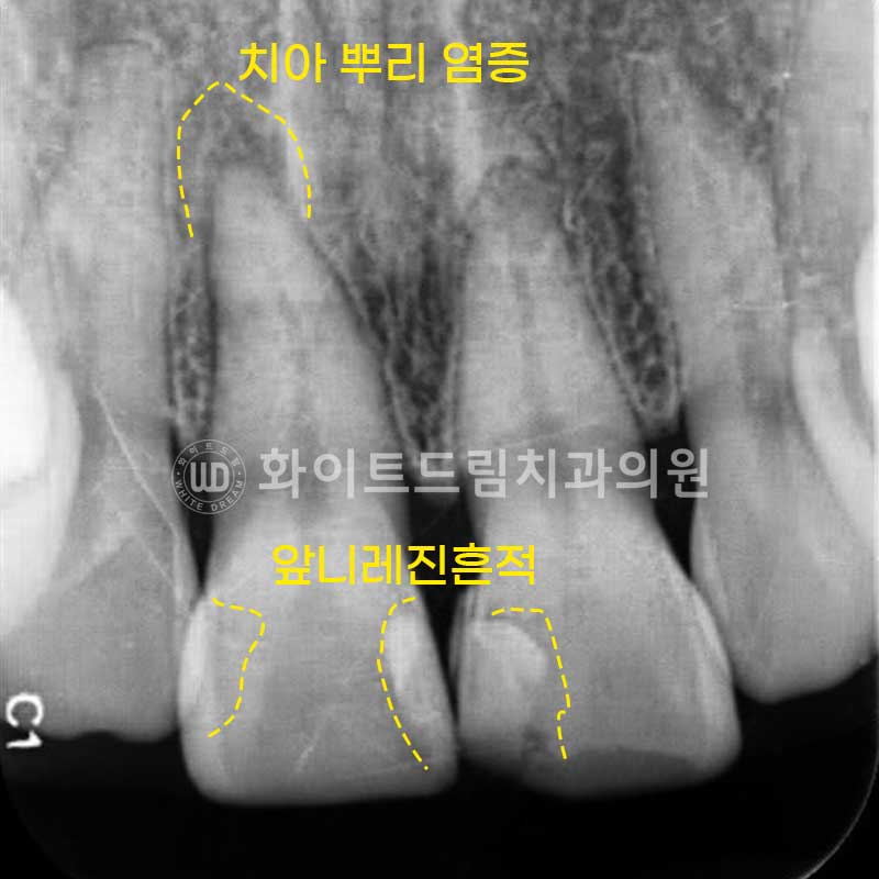 신논현라미네이트, 중년 충치치료, "치경부 우식증, 라미네이트로 당일 치료 OK" 관련 이미지 7