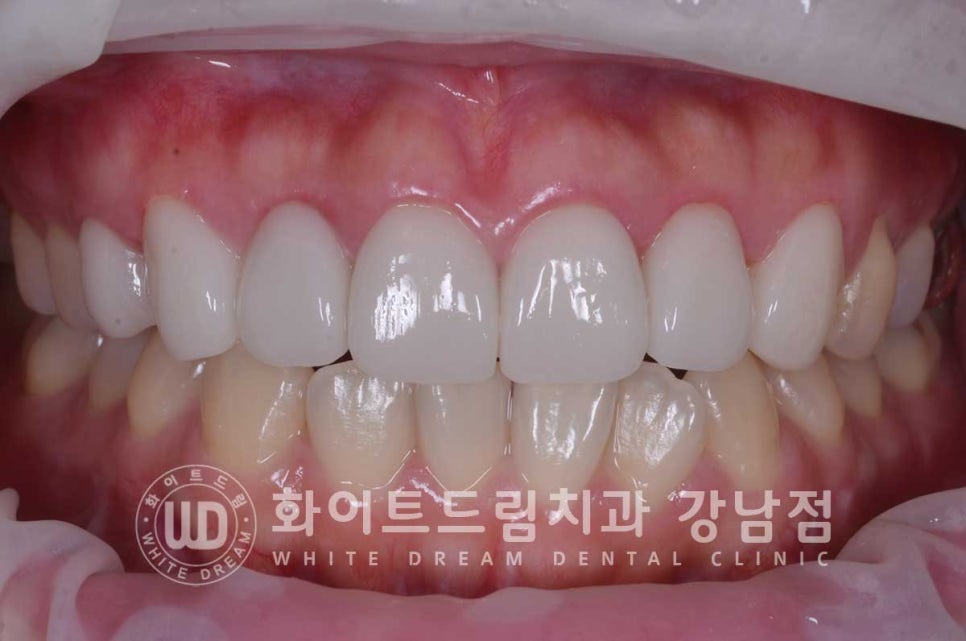 신경치료 후 크라운을 씌워야 하는 이유 & 신경치료 후 변색 치료 Case 리뷰 관련 이미지 12