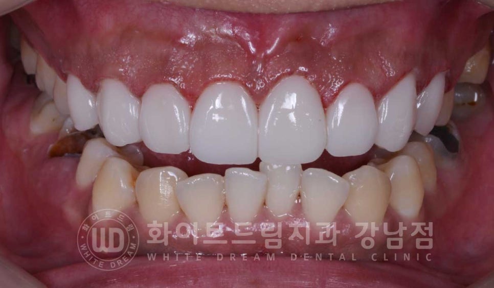 틀어진 치아 라미네이트, 틀어지고 색이 다른 앞니가 고민이에요. 관련 이미지 11