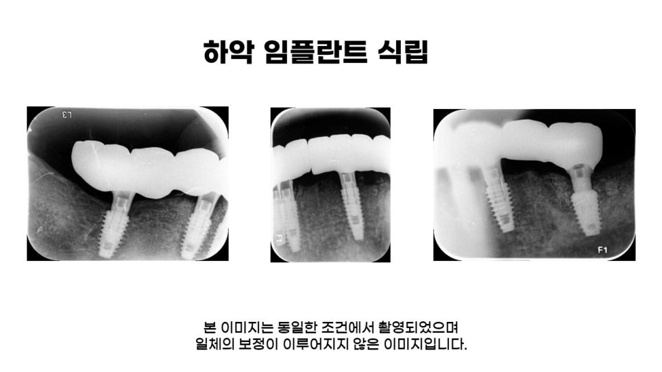 40대임플란트식립후기 및 어금니임플란트 가격, 종류 알아보기 위해 관련 이미지 14