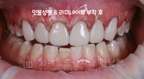 강남역 라미네이트 "치아가 작고 벌어졌어요" 거미스마일 + 벌어진 치아 개선 관련 이미지 9