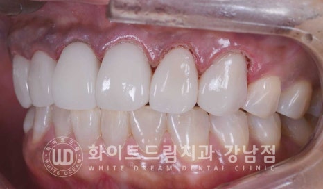 깨진앞니 라미네이트 / 깨지고 누렇게 변한 앞니는? 원데이 라미네이트 치료 사례 관련 이미지 12