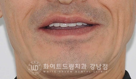 치주염 전체임플란트, 염증으로 인한 상악동 천공 & 신경관 가까이 녹은 잇몸뼈. 임플란트 식립 가능할까? 관련 이미지 2