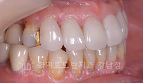 노화된 치아 라미네이트 / 치아미백을 해도 하얘지지 않는 마모된 치아는 어떻게 할까? 관련 이미지 17