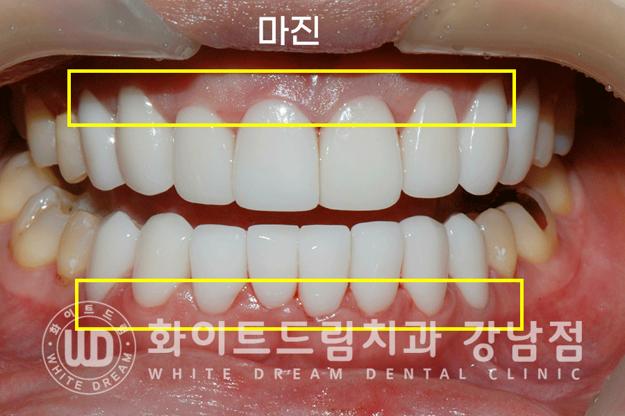 강남역 앞니라미네이트 "틀어진 토끼 앞니 빠르게 개선" 강남역 라미네이트 치과 관련 이미지 10