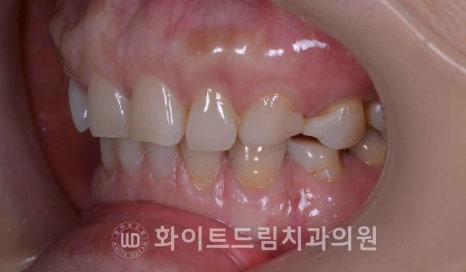 강남옹니라미네이트 "치아가 안으로 들어가서 할머니처럼 보여요" 경미 & 중증도 옹니 라미네이트 치료 관련 이미지 5