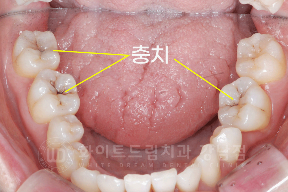 강남 덧니 비발치교정 / 임플란트와 치아교정 동시 진행 case 리뷰. 관련 이미지 10