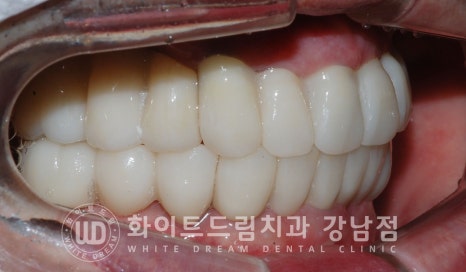 40대 전체임플란트 / 디지털스캔바디를 이용한 전체 임플란트 치료 사례 (Feat. 치주염) 관련 이미지 24