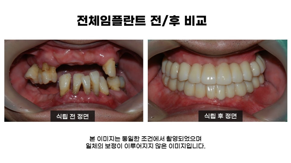 40대임플란트식립후기 및 어금니임플란트 가격, 종류 알아보기 위해 관련 이미지 15