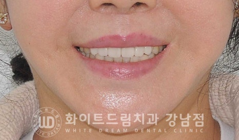 앞니라미네이트 교체 "5년 전에 한 라미네이트가 뻗쳐 보여요" 예쁘게 치료할 수 있나요? 관련 이미지 13