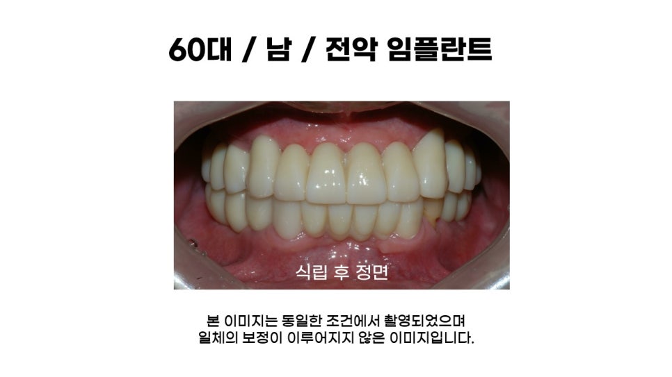 60대 전악임플란트후기 및 치료기간 관련 이미지 9