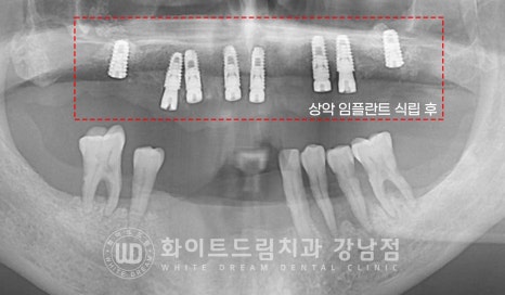 치주염 전체임플란트, 염증으로 인한 상악동 천공 & 신경관 가까이 녹은 잇몸뼈. 임플란트 식립 가능할까? 관련 이미지 10