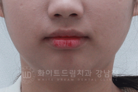 신논현역 라미네이트 / 과개교합 치아교정 + 왜소치 라미네이트 진행 case 관련 이미지 7