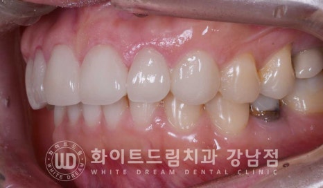 앞니 원데이라미네이트 / 떨어진 앞니 레진 & 벌어진 앞니, 라미네이트로 당일 개선 ★ 관련 이미지 12